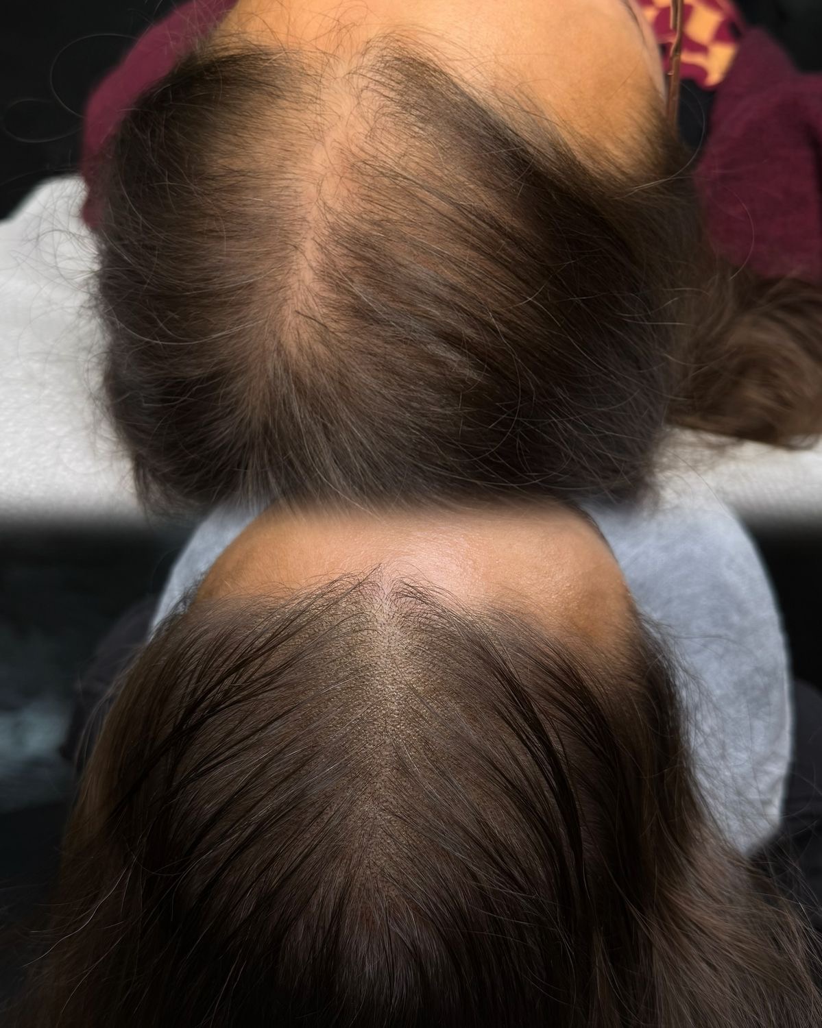 Microhaarpigmentatie (SMP)